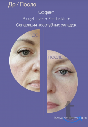 Модель на Smas Лифтинг в Москве