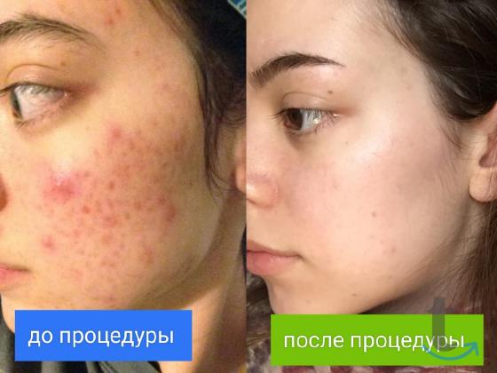 Модель на Smas Лифтинг в Москве
